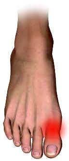 For eksempel kan man opdage gigt i fødderne ved, at tæerne hæver og bliver røde, og. En Stiv Storeta Hallux Rigidus Klinik For Fodterapi Ved Kia Remond