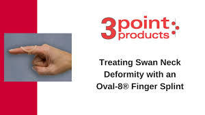 A swan neck deformity affects the fingers and causes them to arch backwards at the center, resembling a swan's neck. Swan Neck Deformity Physiopedia