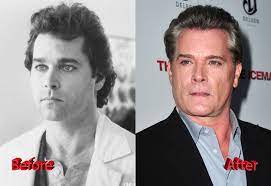 Ray liotta plastic surgery before and after american actor, film producer explained here at this page ray liotta before plastic surgery and after ray . Ray Liotta Plastic Surgery A Strange Looking Goodfella Plastic Surgery Mistakes