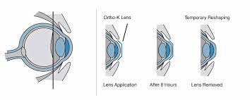 What Is Orthokeratology 2 Effective Alternatives To Wearing Glasses Real Eyes Optometry