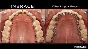 The lingual braces are fitted over two. Inbrace Lingual Braces District Orthodontics 202 899 5529