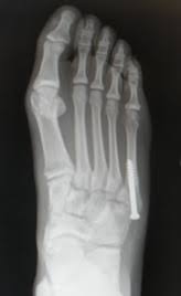 Historically, acute 'jones' type fractures as well as the stress fracture were treated in a cast of however, it was noted that healing was particularly poor with both types of fracture. Jones Fracture 5th Metatarsal Stress Fracture