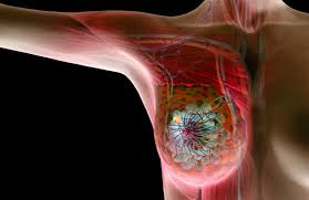 These small wart like lumps grow in the lining of the mammary ducts, near the nipple. Breast Lumps Cancerous Vs Noncancerous