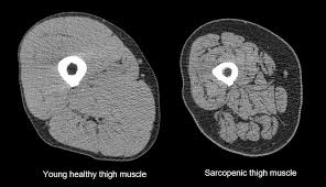 Sarcopenia is the gradual loss of muscle mass that can affect people in their 30s and beyond. The Muscle Wasting Condition Sarcopenia Is Now A Recognised Disease But We Can All Protect Ourselves