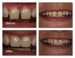 So how do dentists close gaps gap teeth can result from several issues. Closing Gaps Gallery Dr Jack M Hosner D D S