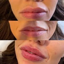 Lip Filler Dissolving: A Comprehensive Guide - Cosmetic Connection