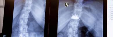 Operative Leistungen Bandscheiben Operation Hws Lws Uvm