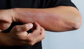 Image result for Skin Infection