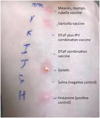 Check spelling or type a new query. Immune Mediated Adverse Reactions To Vaccines Stone 2019 British Journal Of Clinical Pharmacology Wiley Online Library