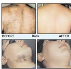I searched long and hard to find an affordable laser hair removal treatment and i feel like i made more. Laser Hair Removal In Pune Stop Ajmera Colony Ajmera Pimpri By Sj Radiance Id 18557191555