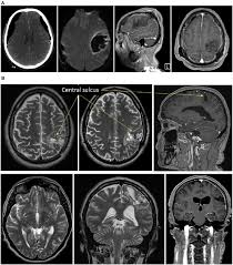 Image result for Brain Lesion