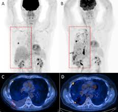 Maybe you would like to learn more about one of these? Pet Ct Variants And Pitfalls In Lung Cancer And Mesothelioma Sciencedirect