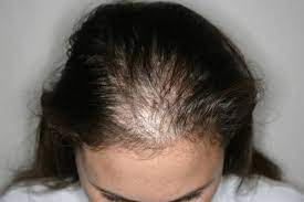 When your hair grows, it starts at the scalp and comes from a hair follicle. How Thyroid Conditions Cause Hair Loss Estegrande Hair Transplant