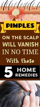 Pimples On Scalp Will Vanish In No Time By Using These 5 Amazing Home Remedies Scalp Pimples Acne Hai Pimples On Scalp Scalp Acne Home Remedies For Pimples