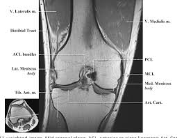 Radiology imaging medical imaging subscapularis muscle shoulder anatomy bicep tendonitis mri brain shoulder rehab rotator cuff tear anatomy this mri knee cross sectional anatomy tool is absolutely free to use. Figure 12 From Normal Mr Imaging Anatomy Of The Knee Semantic Scholar