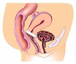 Silicone may also make a pessary easier to clean. Pessary Information Peak Physio