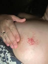 The inflammation and the lymph node might extend to underarms and in collar bones too. Rash On Breast Pics October 2020 Babies Forums What To Expect