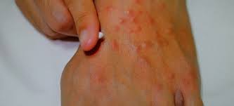 Image result for ant bite