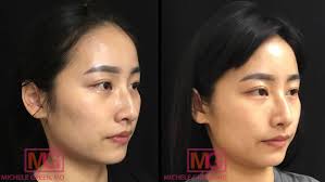 The lumenis lightsheer infinity laser allows people with all skin types and ethnicities to enjoy the benefits of laser hair removal. Asian Skin Treatment Nyc Asian Skin Dermatologist