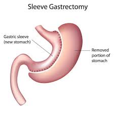 gastric sleeve mexico cost bariatric