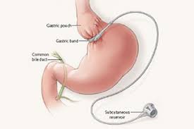 Bariatric surgery is only employed when other methods of weight loss have been tried and failed. Should I Have Bariatric Surgery Before My Pregnancy Your Pregnancy Matters Ut Southwestern Medical Center