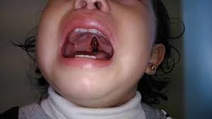 Esta hendidura deja un hueco entre la nariz y la boca. Labio Leporino Wikiwand