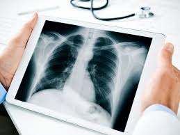 Lung cancer chest xray films. Hypoechoic Mass In The Liver Breast Kidney And More