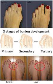 How To Prevent And Treat Bunions Alldaychic Health And Beauty Tips Health Remedies Body Health