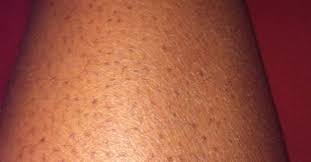 What Are Strawberry Legs Strawberry Legs Is A Condition You Experience When Little Black Dots D Strawberry Legs Dark Spots On Skin Black Skin Care Dark Spots