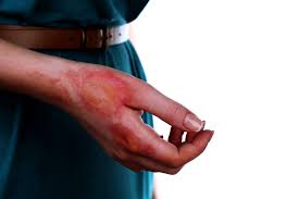 Image result for Hand Injury