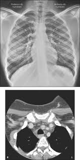 Only at word panda dictionary. Bony Thorax Radiology Key