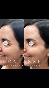 ✨Pequeños cambios, grandes resultados. Antes y después de la aplicación de  toxina botulínica.✨, Toxina botulínica, tratamiento médico que relaja de  manera temporal los músculos responsables de las ...