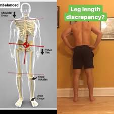 Image result for Functional Leg Length Discrepancy