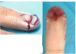 Dec 16, 2020 · by removing a nail, you can help prevent infection and help the nail heal from an injury. Nail Trauma Intechopen