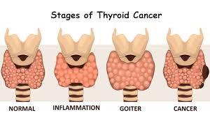 The thyroid is an endocrine gland located in the region of the neck, in front of the trachea, and below the thyroid cartilage. Thyroid Cancer Archives Oncoplus Hospital