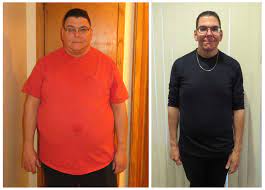 See his full gastric sleeve before and after. Marcus Drops 140 Pounds In 12 Months After Gastric Sleeve Prime Surgicare