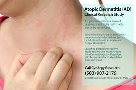 Image result for Atopic Dermatitis