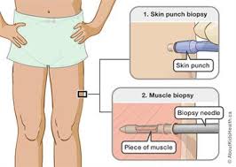 Homework for lasalle college of the arts: Skin And Muscle Biopsy Using Image Guidance