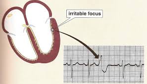 Pvc Arrhythmia Changes The Normal Shape Pvc Originates Suddenly In Download Scientific Diagram