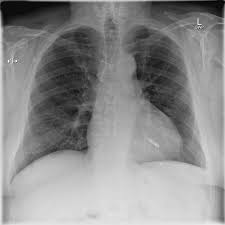 During surgery, your doctor or cardiologist will insert a wire into a large vein under your. Leadless Cardiac Pacemaker Radiology Case Radiopaedia Org