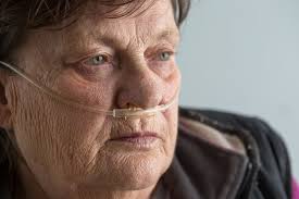 Moderate and Severe IPF Also Benefit from Esbriet, Analyses Suggest