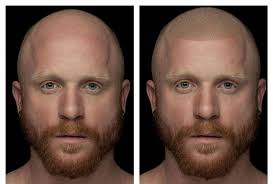 Ali safieddine leading the area for 7 years most successful procedure . What Is Scalp Micropigmentation