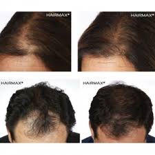 If your hair loss is caused by an underlying disease, treatment for that disease will be necessary. Laser Hair Loss Treatment Therapy New Orleans Hair Salon Hair Restoration New Orleans