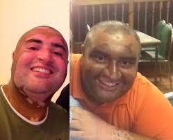 Guru's progress, clinical trials, Crowdfunding Vitiligo research and  Twitter