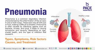 Image result for Pneumonia