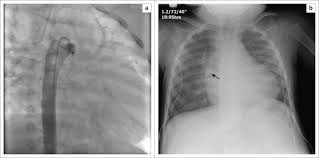 They are now what make the heart beat normally because our own muscles cannot do that anymore. Chest Radiographs Of Cardiac Devices Part 1 Cardiovascular Implantable Electronic Devices Cardiac Valve Prostheses And Amplatzer Occluder Devices Abstract Europe Pmc