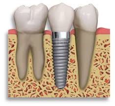 Periodontal Specialist Gum Disease Specialist Cotswold Periodontal Centre Dental Implants