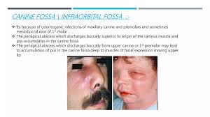 Image result for phlegmon on face)