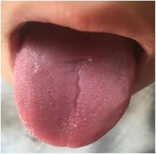 Image result for Fissured tongue