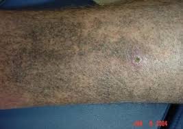 Image result for Pigment stains on the shin